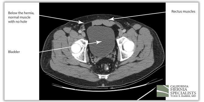 Spigelian Hernia CT image